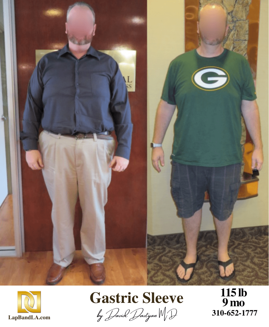 Bariatric Surgery Before and After – M.P.