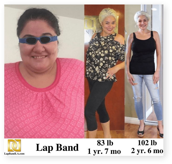 Lap band surgery before and after
