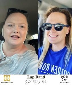 bariatric surgery before and after