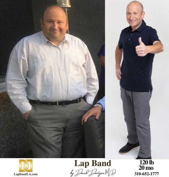 1_Bariatric-Surgery-Before-_-After-Weight-Loss-Lap-Band-Gastric-Sleeve-Gastric-Bypass-Gastric-Balloon-9