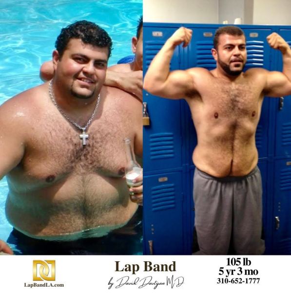 1_Lap-Band-Before-After-Bariatric-Surgery-Photo-1