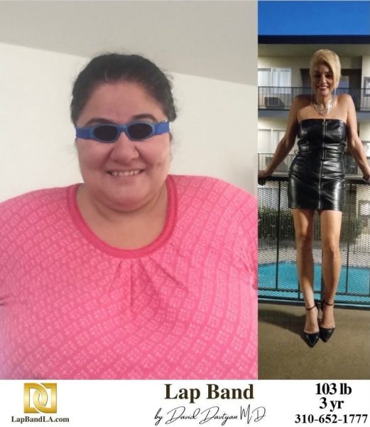 Bariatric Surgery - Before & After Weight Loss - Lap Band