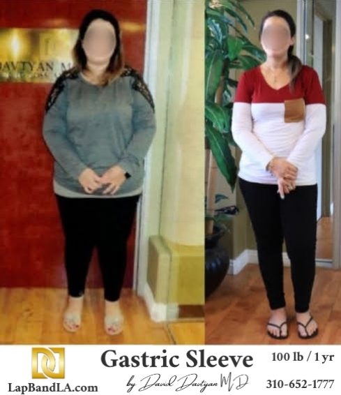 Lap-Band-Before-After-Bariatric-Surgery-Photo-1-46