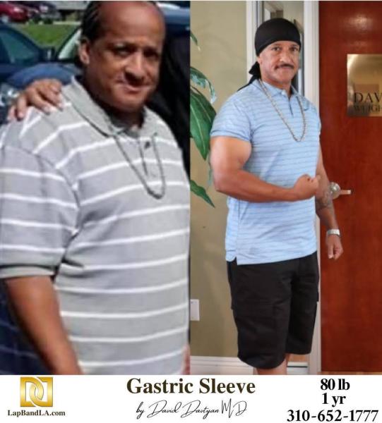 Weight-Loss-Surgery-Bariatric-Surgery-Gastric-Band-Lap-Band®-_-Gastric-Sleeve