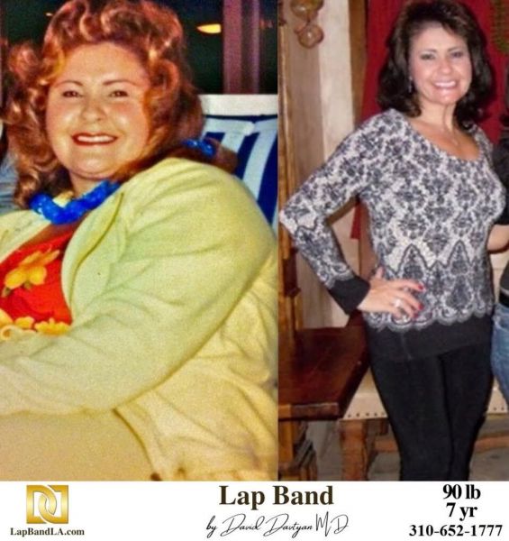 Bariatric Surgery - Before & After Weight Loss - Lap Band