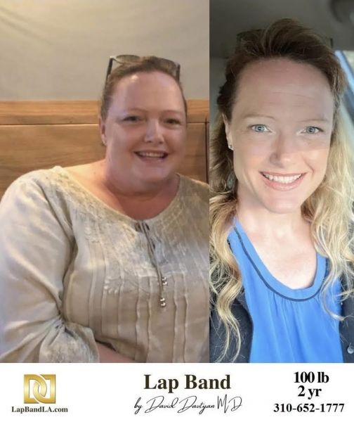 Bariatric Surgery - Before & After Weight Loss - Lap Band