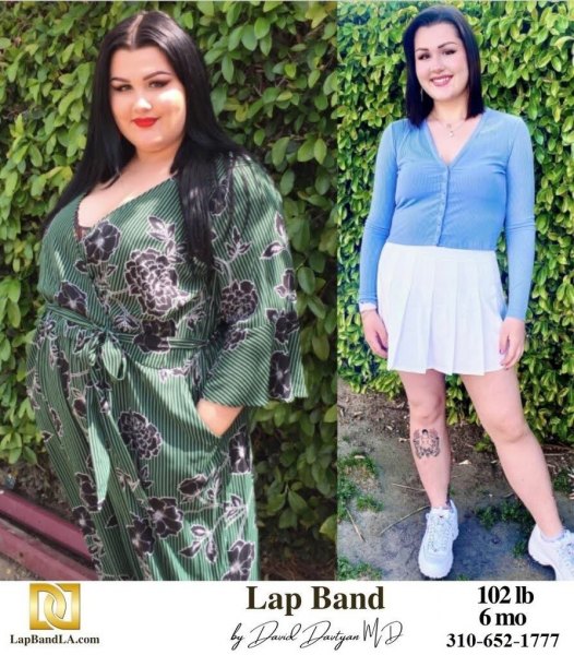 Bariatric Surgery - Before & After Weight Loss - Lap Band