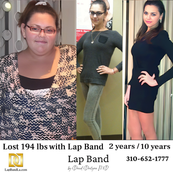 Lap-Band-Before-and-After-Aleksandra-Tukan-LBLA-branded