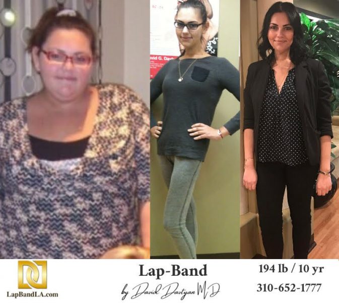 Lap-Band-Surgery-Before-and-After-Weight-Loss-Surgery-Center-Of-Los-Angeles-in-Beverly-Hills-Glendale-Rancho-Cucamonga-Fountain-Valley