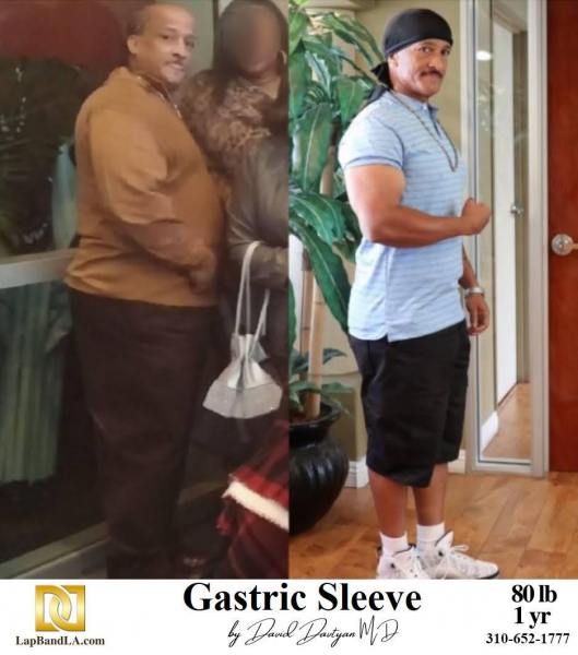 Before & After Gastric Sleeve Surgery by Dr Davtyan