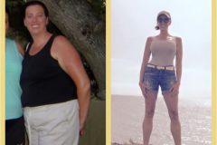 Bariatric Surgery - Before & After Weight Loss - Lap Band