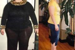 Lap-Band-Before-_-After-Bariatric-Surgery-Photo-2
