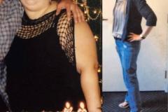 Bariatric Surgery - Before & After Weight Loss Surgery Photo - Gastric Band Sleeve Bypass Balloon