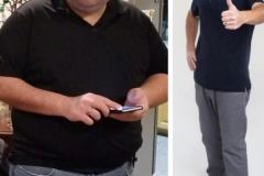Bariatric Surgery - Before & After Weight Loss Surgery Photo - Gastric Band Sleeve Bypass Balloon