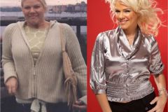 Bariatric Surgery - Before & After Weight Loss Photo - Lap-Band® Patient