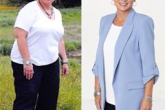Bariatric Surgery - Before & After Weight Loss Photo - Lap-Band® Patient