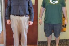 Bariatric Surgery - Before & After Weight Loss Surgery Photo - Gastric Band Sleeve Bypass Balloon