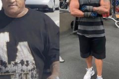 Bariatric Surgery - Before & After Weight Loss Surgery Photo - Gastric Band Sleeve Bypass Balloon