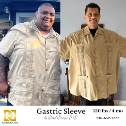 Dr. Davtyan gastric sleeve patient lost 120 lbs in just 4 months after surgery