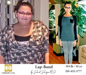 Bariatric Surgery - Before & After Weight Loss Surgery Photo - Gastric Band Sleeve Bypass Balloon