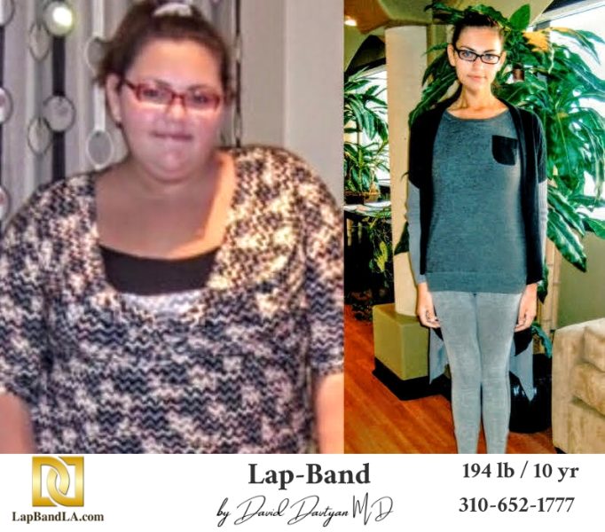 Bariatric Surgery - Before & After Weight Loss Surgery Photo - Gastric Band Sleeve Bypass Balloon
