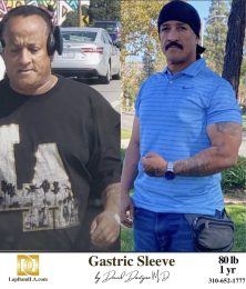 Bariatric Surgery - Before & After Weight Loss Surgery Photo - Gastric Band Sleeve Bypass Balloon