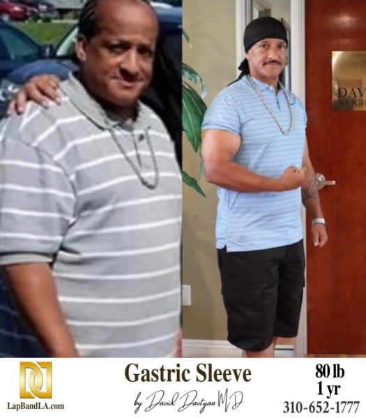 Bariatric Surgery - Before & After Weight Loss Surgery Photo - Gastric Band Sleeve Bypass Balloon