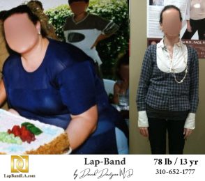 Bariatric Surgery - Before & After Weight Loss Surgery Photo - Gastric Band Sleeve Bypass Balloon