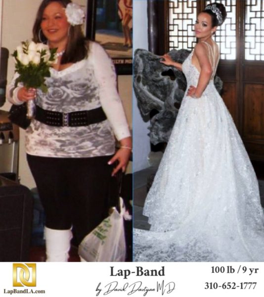 Bariatric Surgery - Before & After Weight Loss Surgery Photo - Gastric Band Sleeve Bypass Balloon