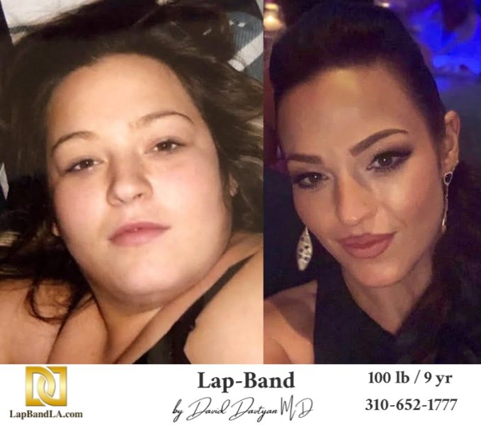 Bariatric Surgery - Before & After Weight Loss Surgery Photo - Gastric Band Sleeve Bypass Balloon