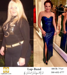 Bariatric Surgery - Before & After Weight Loss Surgery Photo - Gastric Band Sleeve Bypass Balloon