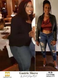 Bariatric Surgery - Before & After Weight Loss Surgery Photo - Gastric Band Sleeve Bypass Balloon