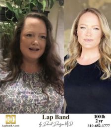Bariatric Surgery - Before & After Weight Loss Surgery Photo - Gastric Band Sleeve Bypass Balloon