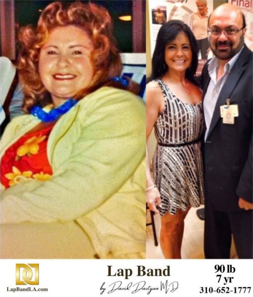 Bariatric Surgery - Before & After Weight Loss Surgery Photo - Gastric Band Sleeve Bypass Balloon