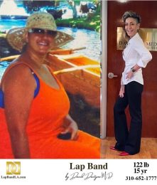 Bariatric Surgery - Before & After Weight Loss Surgery Photo - Gastric Band Sleeve Bypass Balloon