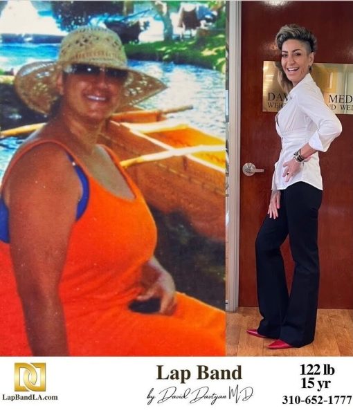 Bariatric Surgery - Before & After Weight Loss Surgery Photo - Gastric Band Sleeve Bypass Balloon