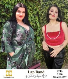 Bariatric Surgery - Before & After Weight Loss Surgery Photo - Gastric Band Sleeve Bypass Balloon