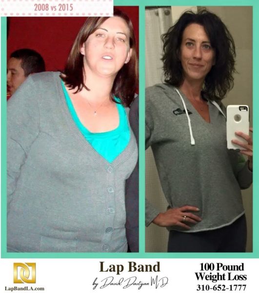Bariatric Surgery - Before & After Weight Loss Surgery Photo - Gastric Band Sleeve Bypass Balloon