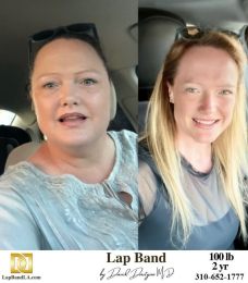 Bariatric Surgery - Before & After Weight Loss Surgery Photo - Gastric Band Sleeve Bypass Balloon