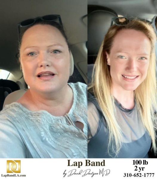 Bariatric Surgery - Before & After Weight Loss Surgery Photo - Gastric Band Sleeve Bypass Balloon