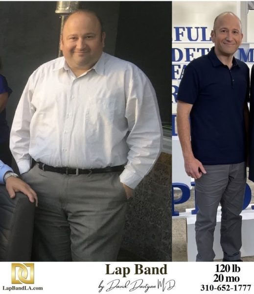Bariatric Surgery - Before & After Weight Loss Surgery Photo - Gastric Band Sleeve Bypass Balloon