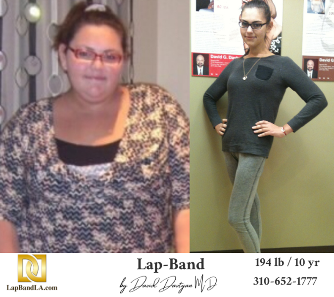 Bariatric Surgery - Before & After Weight Loss Surgery Photo - Gastric Band Sleeve Bypass Balloon