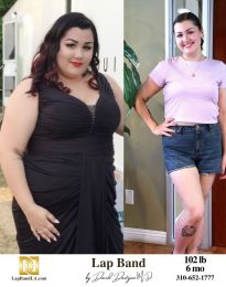 Bariatric Surgery - Before & After Weight Loss Surgery Photo - Gastric Band Sleeve Bypass Balloon