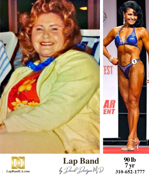 Bariatric Surgery - Before & After Weight Loss Surgery Photo - Gastric Band Sleeve Bypass Balloon
