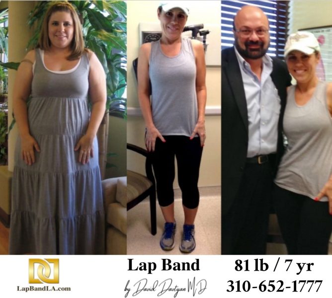 Bariatric Surgery - Before & After Weight Loss Surgery Photo - Gastric Band Sleeve Bypass Balloon