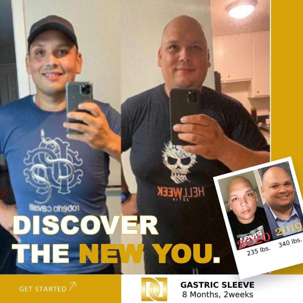 Bariatric Surgery - Before & After Weight Loss Surgery Photo - Gastric Band Sleeve Bypass Balloon