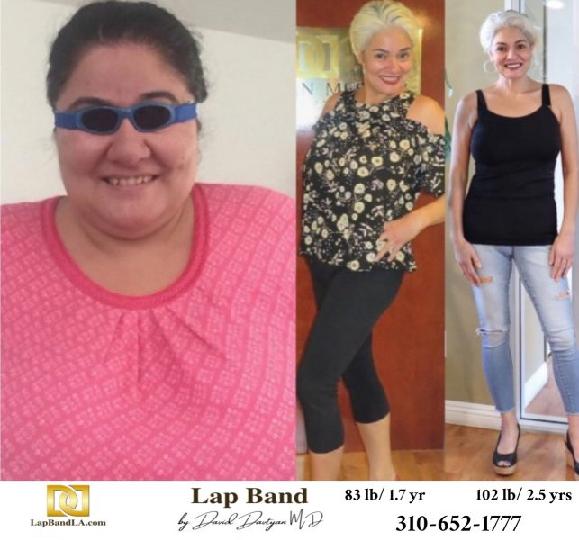 Bariatric Surgery - Before & After Weight Loss Surgery Photo - Gastric Band Sleeve Bypass Balloon