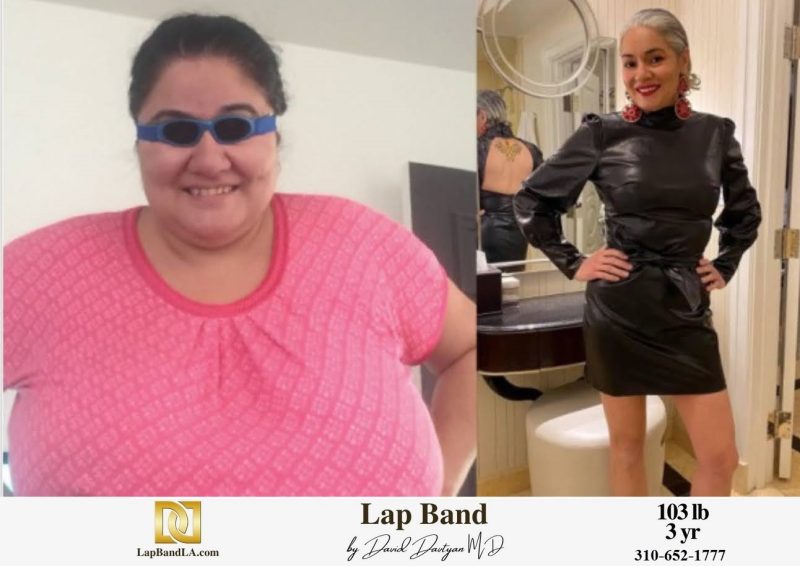Bariatric Surgery - Before & After Weight Loss Surgery Photo - Gastric Band Sleeve Bypass Balloon