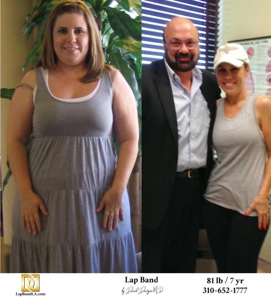 Bariatric Surgery - Before & After Weight Loss Surgery Photo - Gastric Band Sleeve Bypass Balloon