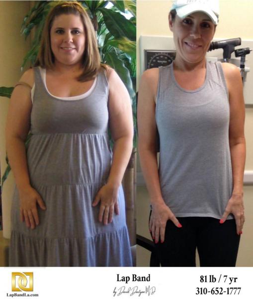 Bariatric Surgery - Before & After Weight Loss Surgery Photo - Gastric Band Sleeve Bypass Balloon